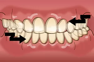 グラインディング