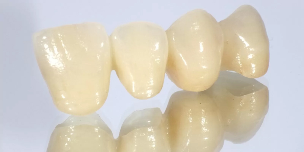 オールセラミッククラウン