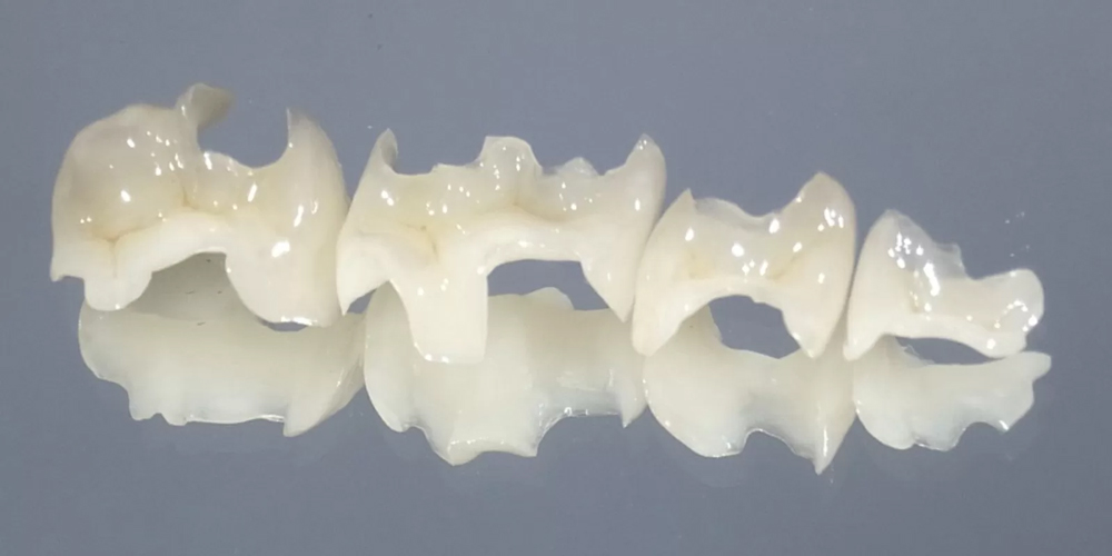 インレー/アンレーとは